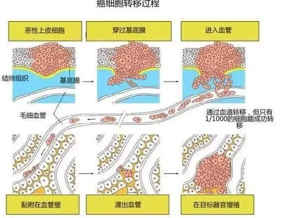 癌症转移