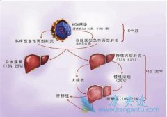 公众对丙肝的危害认识十分有限导致容易出现三大误区