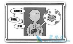 丙肝患者在防控丙肝的危害时应该注意些什么