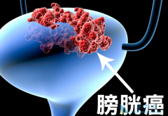 早期膀胱癌症状有尿频尿急尿痛等