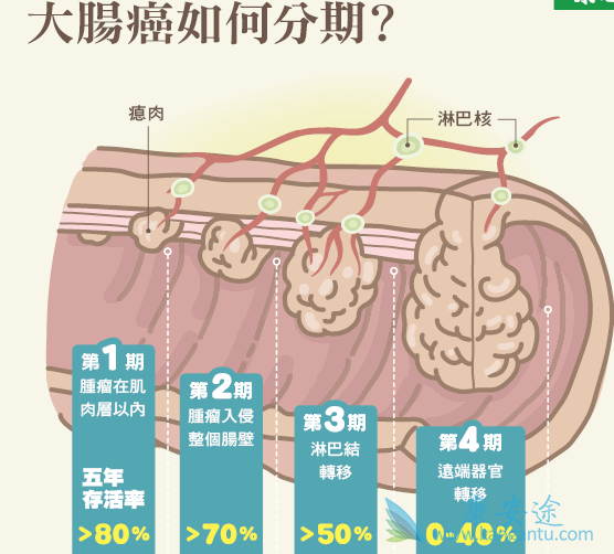 大肠癌症状