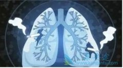 免疫治疗是一种新的晚期肺癌治疗途径 