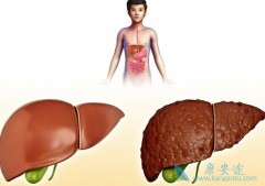 有其他肝脏病史的病人该如何治疗丙肝