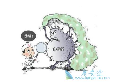 淋巴癌