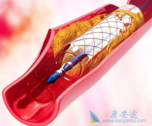 心脏支架手术后