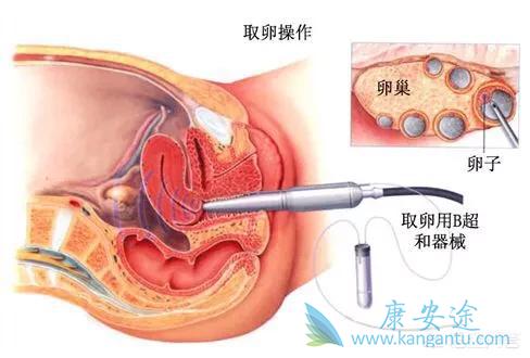 试管婴儿移植后几天着床