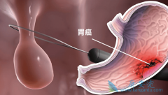 Ī¬(Ramucirumab)mFOLFOX6ܷITTȺPFS