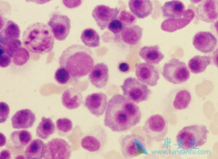 ǶȰ(lenalidomide)ûϸȾ