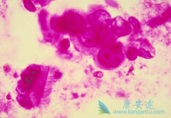 ᵥ(Panitumumab)ϻٰЧ