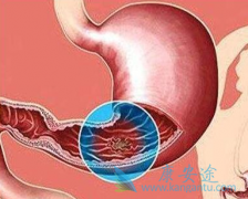 θҪڷø(Imatinib)