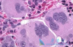 ³(ruxolitinib)ܸƹά֢״