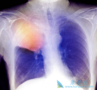 (Lorlatinib)תƻߵЧʸߴ90%