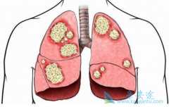 (brigatinib)ԳڷΰߵЧզ