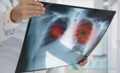 (crizotinib)ڼ仼Ҫת