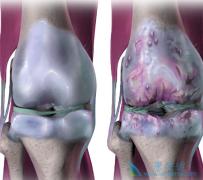 tanezumab治疗骨关节炎患者的疗效怎么样？