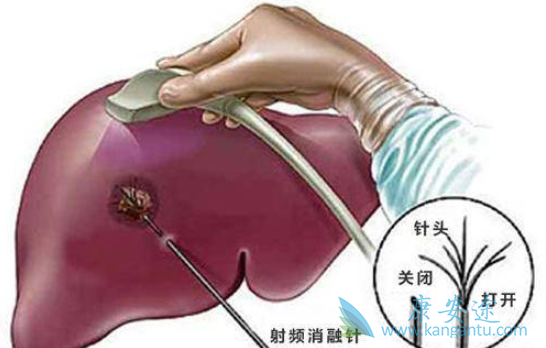 乙肝是什么病